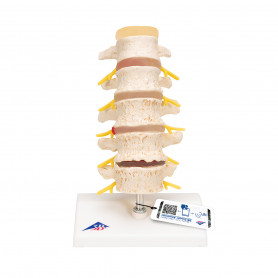 Model coloana lombara, etapele degenerarii vertebrale A795